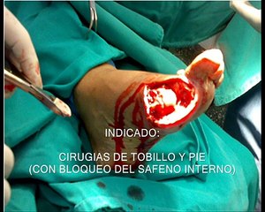 Bloqueo del nervio ciatico popliteo guiado por ultrasonido