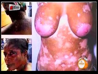 Révélations incroyables sur la dépigmentation des sénégalais