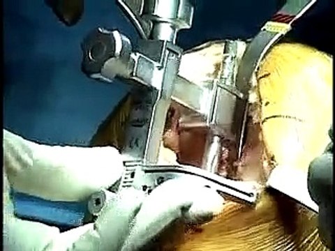 Podcast: Minimally Invasive Total Knee Replacement