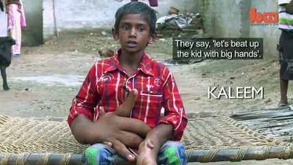 Mystery Condition Gives Indian Boy Gigantic Hands