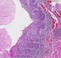 Histopathology Esophagus--Squamous cell carcinoma