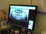 ひろ歯科のレーザー治療