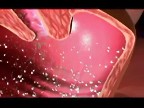 Pelvic Inflammatory Disease Sexually Transmitted Bacterial Infections