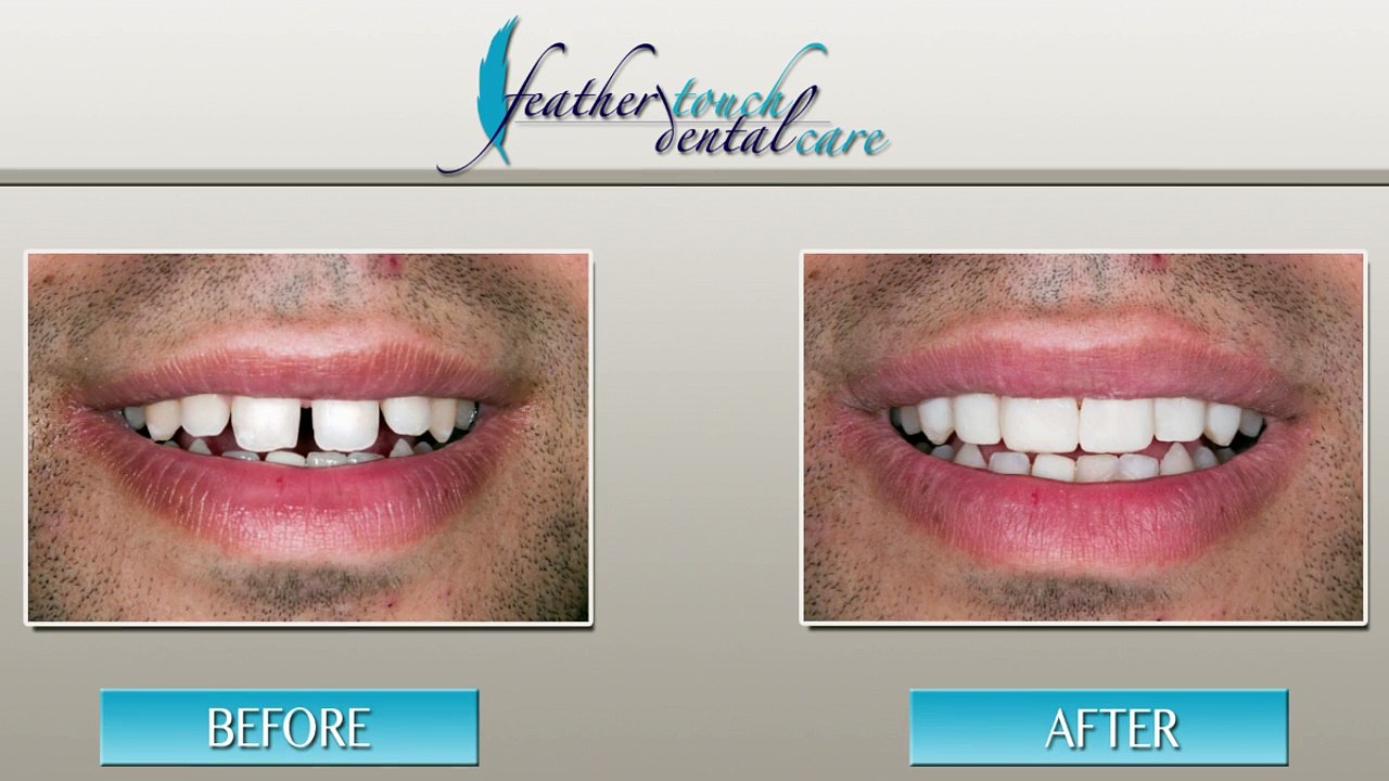 Dental Veneers - Atlanta, GA - Feather Touch Dental Care