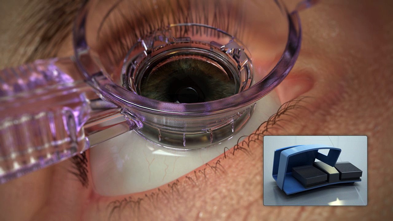 LASIK - Vidéo 2