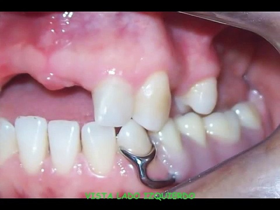 protesis parcial removible superior mujer ppr (dr. paul medina)