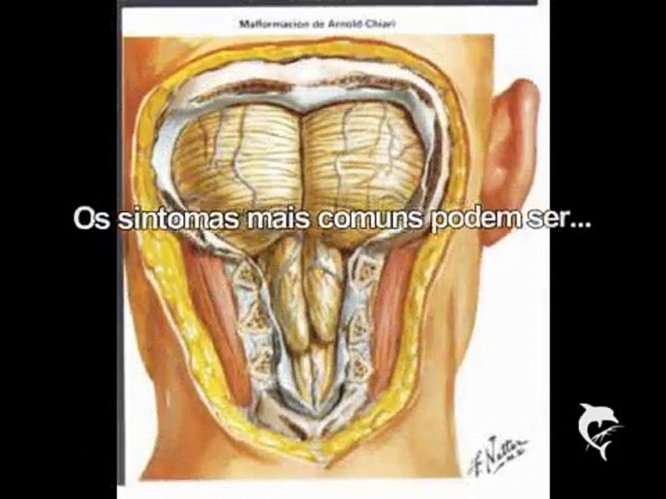 SÍNDROME DE CHIARI TIPO 1