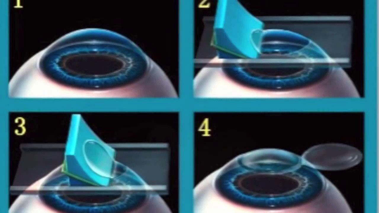 LASIK : A Real Eye Surgery