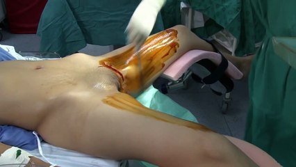 Laparoscopic sterilization with Falope ring and Filshie clip