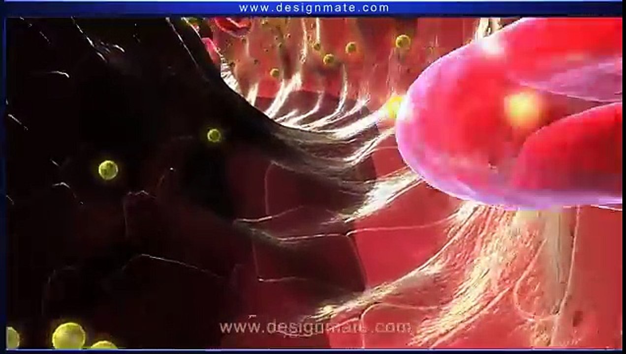 Atherosclerosis (Heart Disease) - Designmate