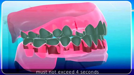 Download Video: Implantes Dentales Sin Cirugía Implantes dentales baratos Madrid Dental implants without surgery impianti dentali