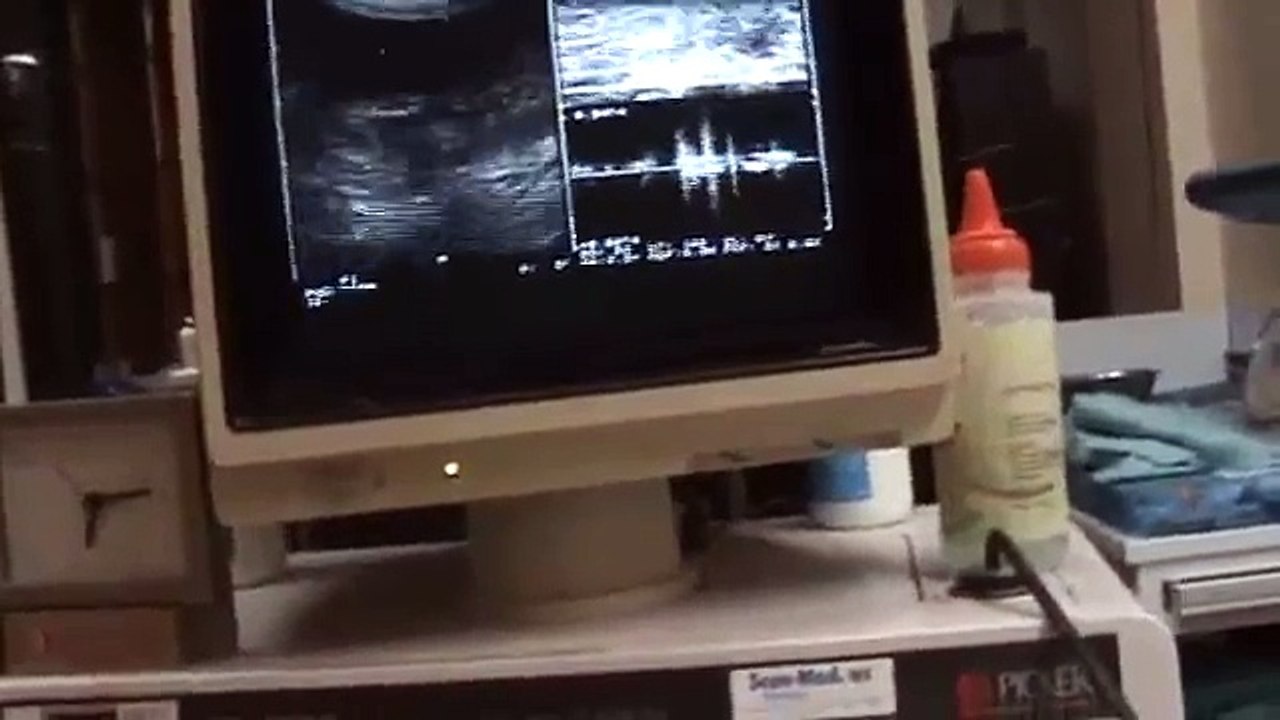 Gestación 7 semanas por ultrasonido transvaginal- Vaginal Scan 7 weeks pregnant