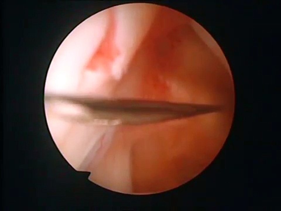 SLAP 2 II Laison Arthroskopie OP Refixation Bizepssehnenanker re. Schulter Labrum [TEIL 1]