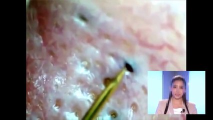 角栓のレーザー治療blackheadできれいな肌を取り戻す