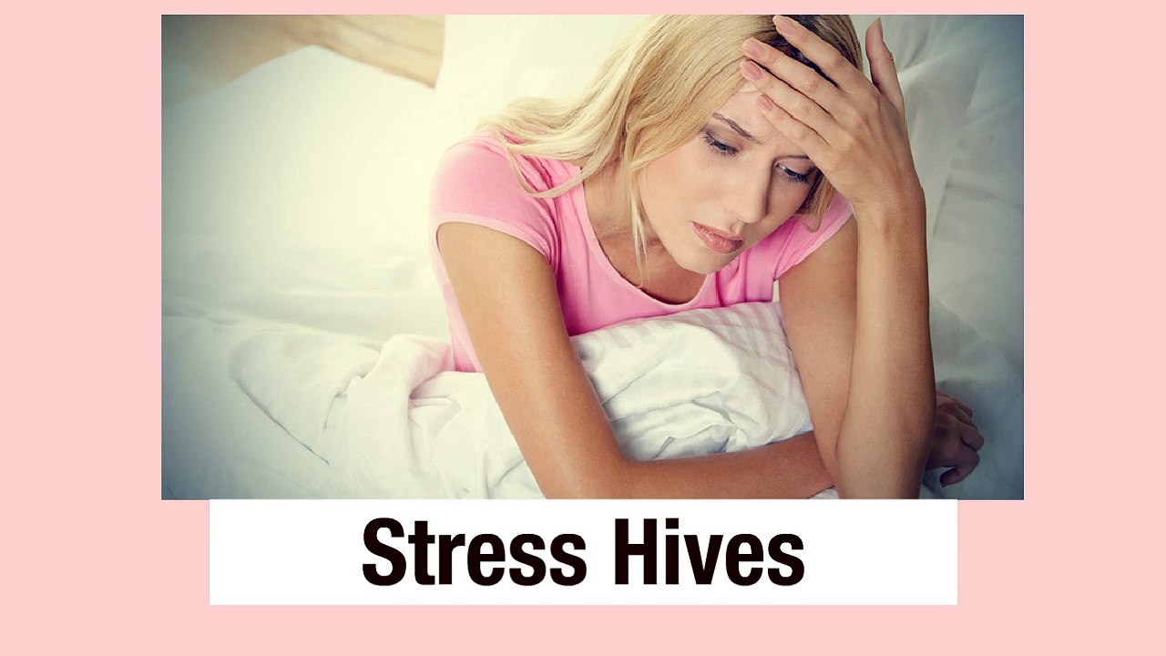 Hives From Stress - How to Treat Stress Hives Fast