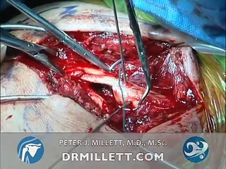 Plate Fixation Surgery for Clavicle Fractures | Broken Collarbone | Vail, Colorado