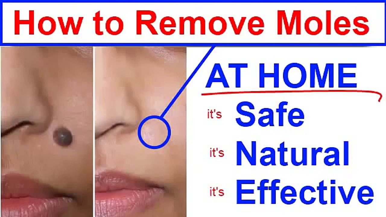 How to Remove Moles? Learn How to Remove Skin Moles at Home