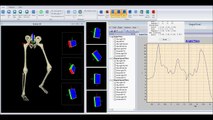 Gait analysis with bluetooth inertial sensors