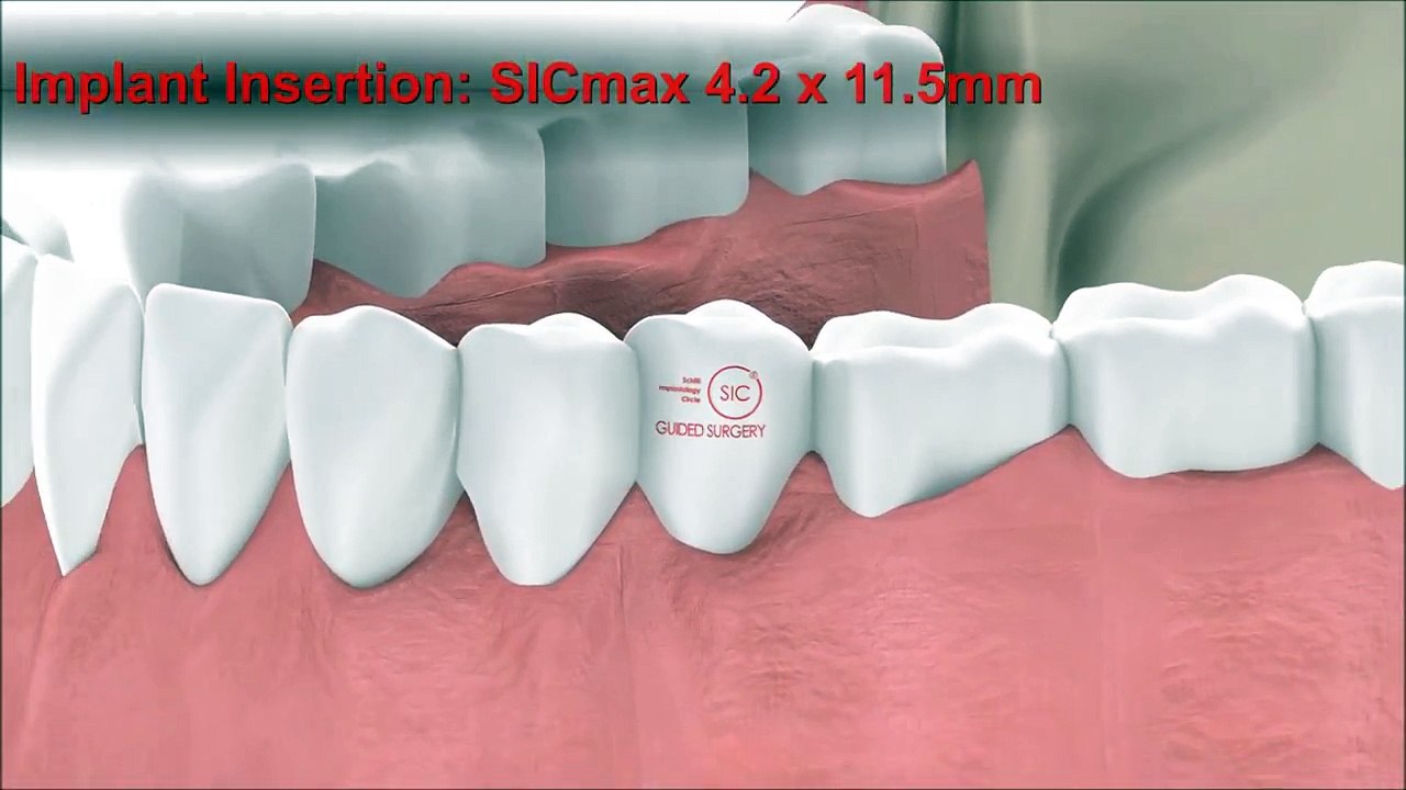 Dental Implantology - Guided Surgery Animation: SICace implant insertion
