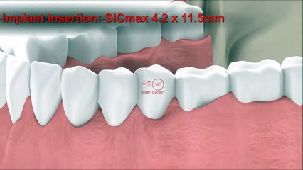 Dental Implantology - Guided Surgery Animation: SICace implant insertion