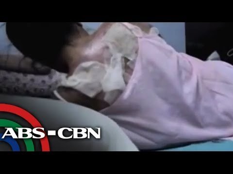 Justice sought for Pinay doused with boiling water