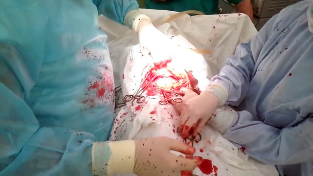 редкие кадры, кесарево сечение(фрагмет) извлечение ребенка в плодном пузыре, Cesarean section.