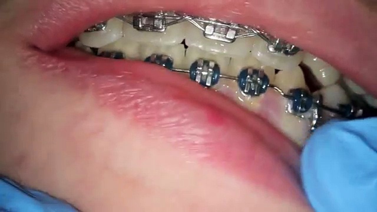 lateral side shift of jaw