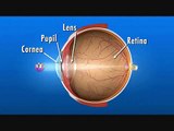 Cataract formation in the eye and cataract surgery