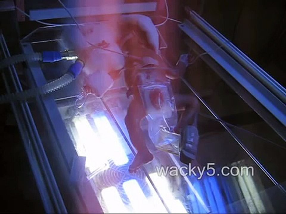 preterm baby 32 weeks on ventilatory support undescended testis