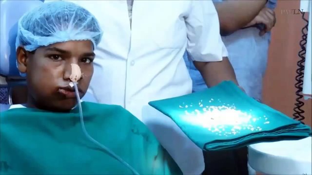 Indian teen Ashik Gavai has 232 Teeth Removed in 7 hours ‘World Record' Surgery