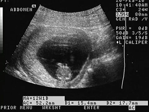 ULTRASONIDO OBSTETRICO DE IMELDA... EMBARAZO DE 12 SEMANAS DE GESTACION...