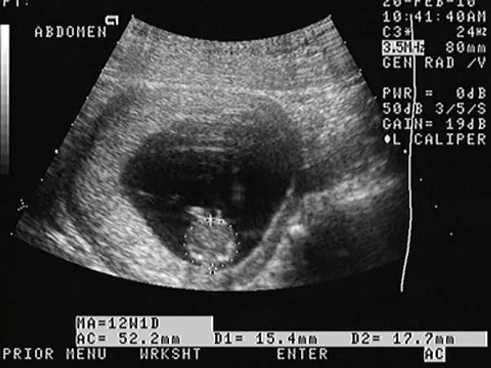 ULTRASONIDO OBSTETRICO DE IMELDA... EMBARAZO DE 12 SEMANAS DE GESTACION...