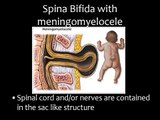 CBNS 169: Taking a Closer Look at Spina Bifida
