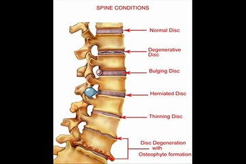 Spinal Stenosis