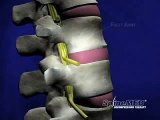 Spinal Decompression Bulging Disc/Herniations - Dr. Wade Burbank, Chiropractor Vancouver WA 98662