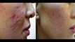 Dermapen Before and After Photos