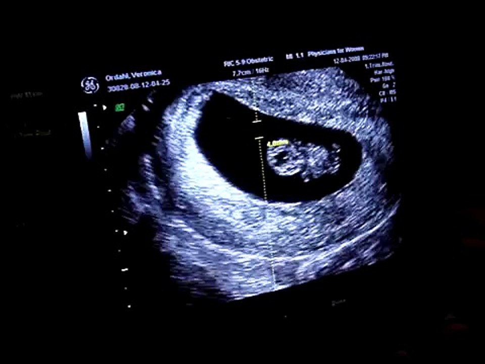 Ultrasound @ 8 weeks 5 days - video Dailymotion