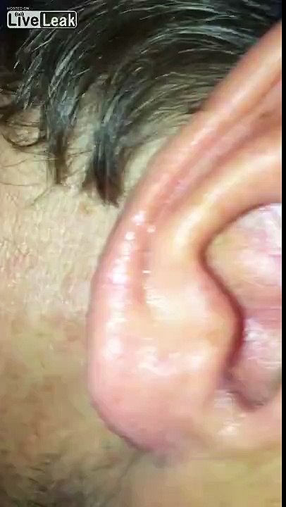 The spider in the ear