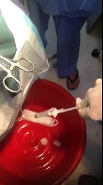 New thermal endometrial ablation