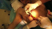 Male Breast Reduction Surgery (Gynecomastia) in Huntington Long Island NY by Dr. Jonathan Lebowitz