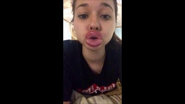 kyliejennerchallenge fails compilation - Des lèvres un peu trop gonflées