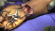 Distal Radius Open Reduction Internal Fixation with Carpal Tunnel Release