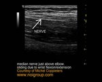 The median nerve slides and glides