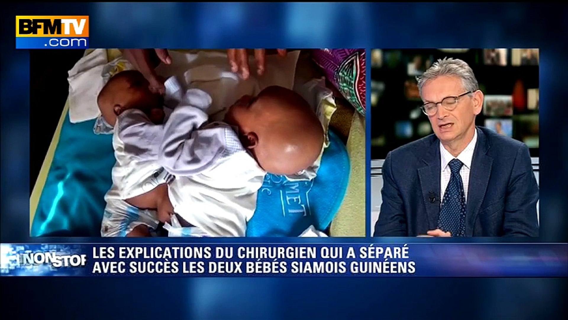 Jumeaux Siamois Separes Une Petite Incertitude Chez L Un Des Bebes Video Dailymotion
