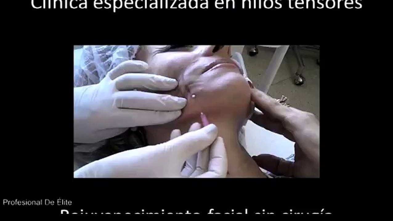 Tratamiento con hilos tensores Miami Lifting Clínica Hilos rusos mágicos V-lift Happy lift Push Up