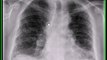 Chest x-ray, idiopathic pulmonary fibrosis, cryptogenic fibrosing alveolitis