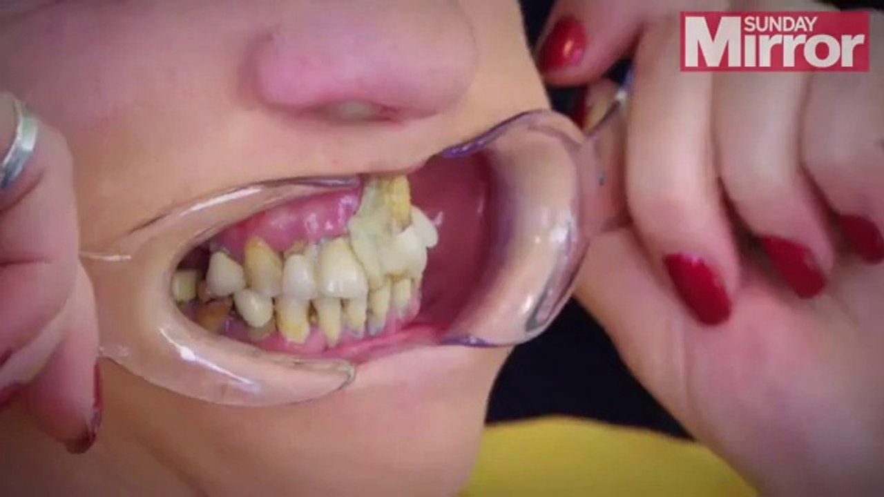 Par peur du dentiste, elle se recolle les dents avec de la super glue
