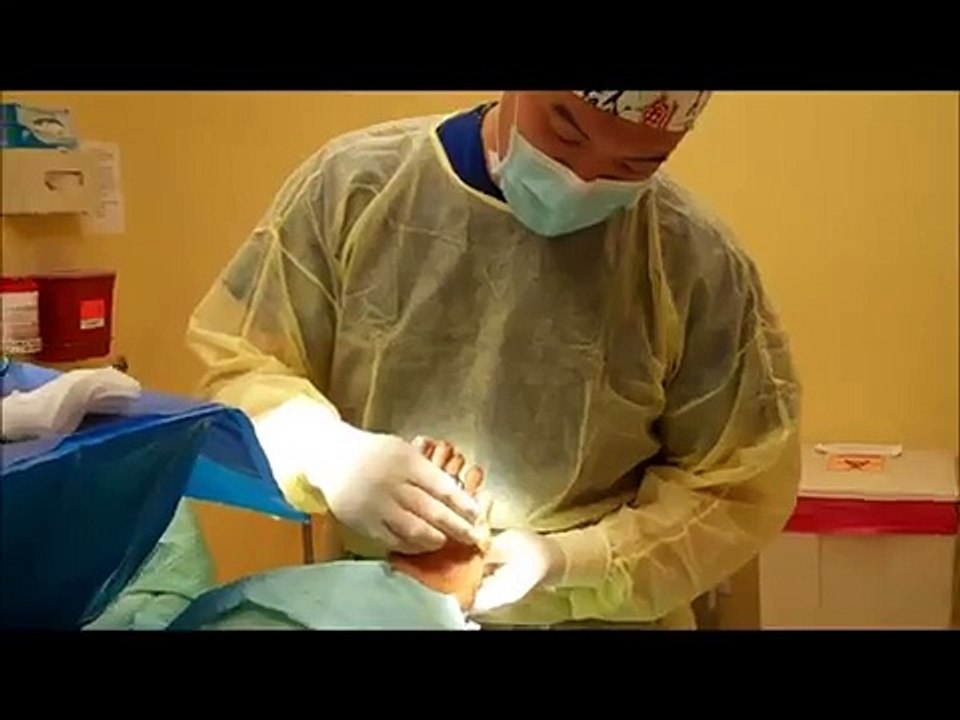 Bunion on 5th toe