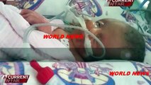 Miracle Conjoined Twins Who Shared A Body DIE After Surviving For 19 Days!!!