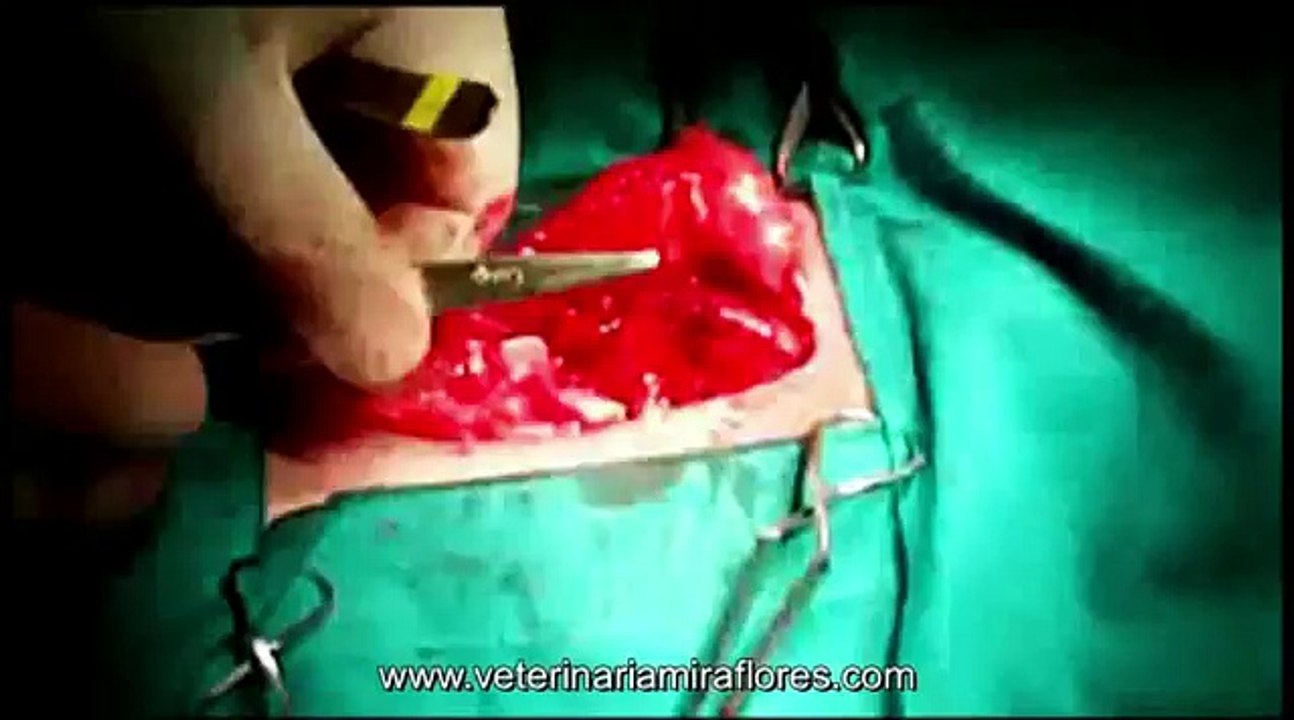 Hernia inguinal usando malla de polipropileno. Cirugía Miraflores del Palo